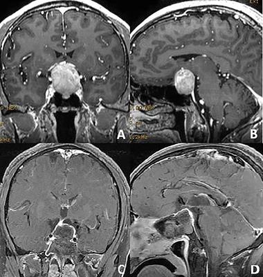 The Use of Micro Retractor in Endoscopic Endonasal Posterior Pseudocapsule Resection of Pituitary Macroadenoma. Technical Note